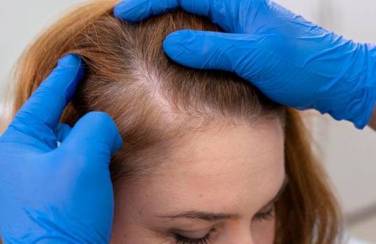 Hair Loss and Hair Fall Treatment