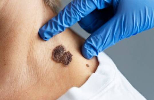 Mole, Wart, and Birth Marks Removal