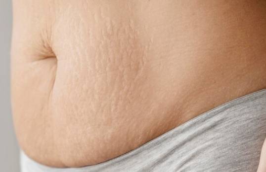Stretch Marks Removal