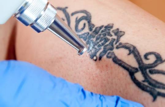 Tattoo Removal