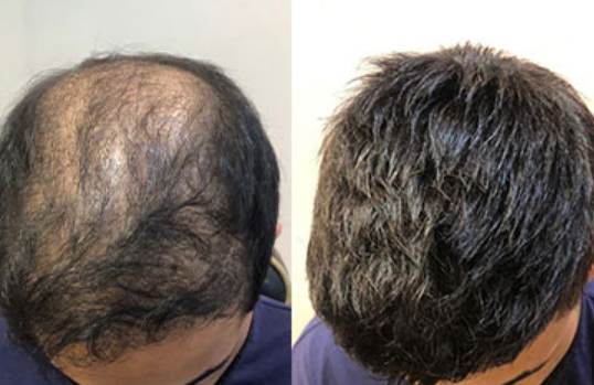 Comprehensive Hair Restoration Comprehensive Hair