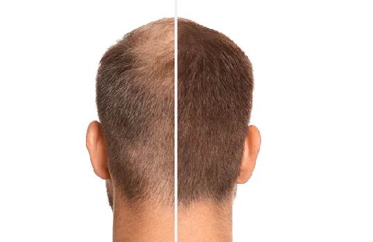 Hair Transplant (FUE & FUT) Hair Loss and Hair Fall Treatment