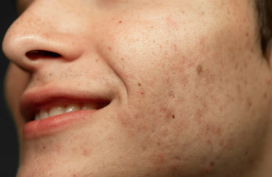 Pigmentation Removal