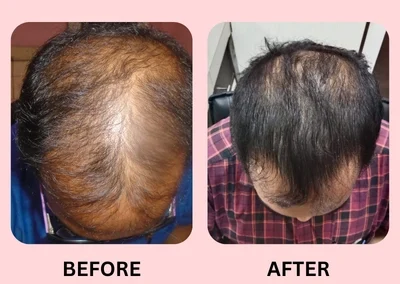 GFC Hair Treatment