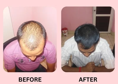 Mesotherapy