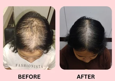 Hair Treatment