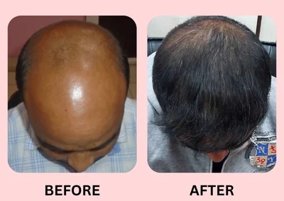 Hair Treatment