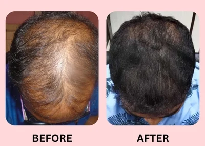 Hair Treatment